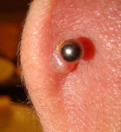 Infected-cartilage-piercing-bump
