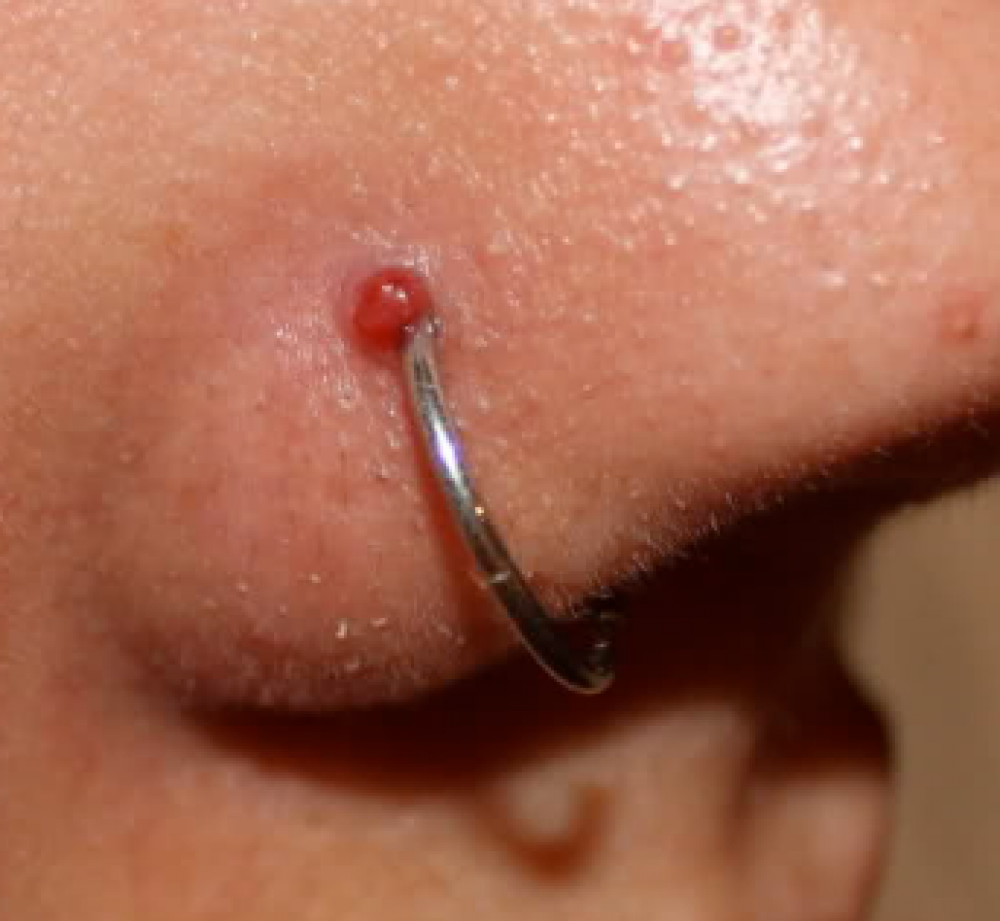 a nose piercing wearing a ring, there is an angry bump of flesh above the ring (disclaimer this was not pierced here)